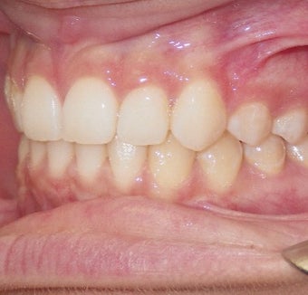 17 or under year old woman treated with Clear Braces after 1567770