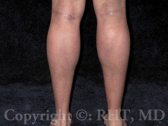 Calf implants after 259428