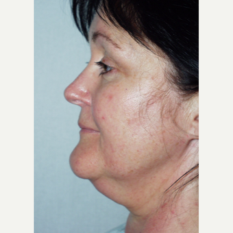 48 year old woman undergoes facelift procedure before 3440052