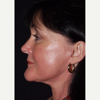 48 year old woman undergoes facelift procedure after 3440052