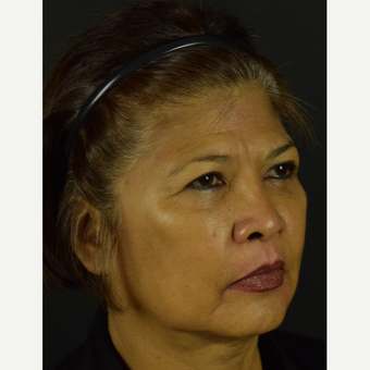 Tightening of the Smile Lines, Corners of the Mouth & Jawline with PDO NovaThreads before 3645199