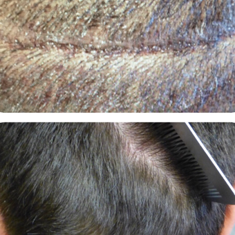 25-34 year old man treated with Hair Transplant before 3222738
