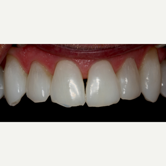 45-54 year old man treated with Invisalign before 3129077