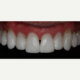 45-54 year old man treated with Invisalign after 3129077
