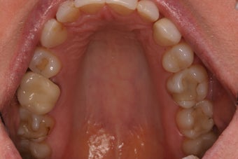 CEREC Same Day Porcelain Crowns on 49 year old Female before 1382002