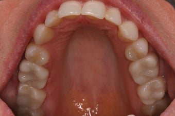 CEREC Same Day Porcelain Crowns on 49 year old Female after 1382002