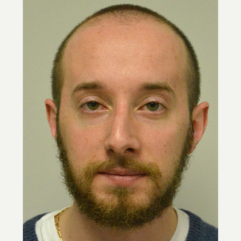 25-34 year old man treated with Nose Surgery before 3099117