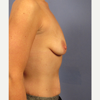 25-34 year old woman treated with Breast Augmentation before 3106675