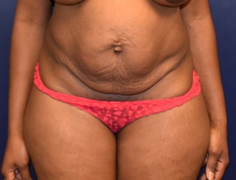 35-44 year old woman treated with Liposuction before 3508657