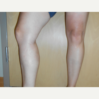 45-54 year old woman treated with Sclerotherapy after 3161493