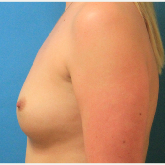 25-34 year old woman treated with Breast Augmentation before 3744065