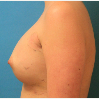 25-34 year old woman treated with Breast Augmentation after 3744065