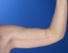 48 Year Old Weight Loss Patient with Arm Laxity 777579