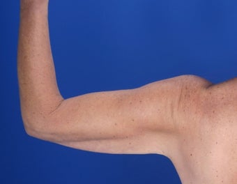 48 Year Old Weight Loss Patient with Arm Laxity before 777579