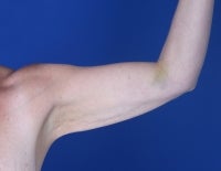 48 Year Old Weight Loss Patient with Arm Laxity 777579