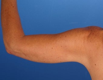 48 Year Old Weight Loss Patient with Arm Laxity after 777579