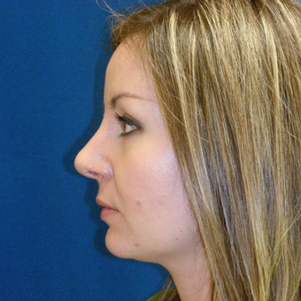 25-34 year old woman treated with Rhinoplasty after 3691890