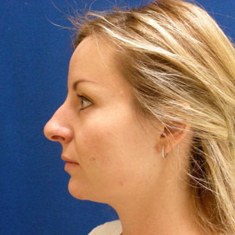 25-34 year old woman treated with Rhinoplasty before 3691890