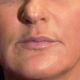 45-54 year old woman treated with Lip Augmentation after 3202045