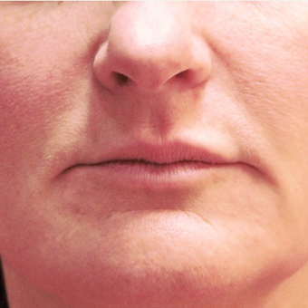 45-54 year old woman treated with Lip Augmentation before 3202045