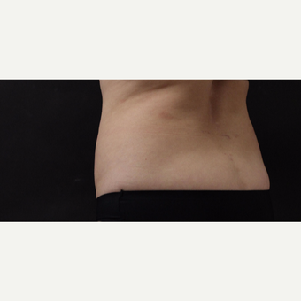 55 year old woman treated with CoolSculpting before 3220716