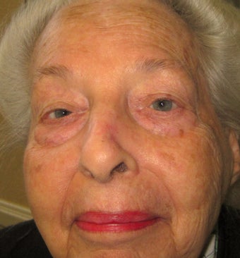 Nasal tumor/mole removal using plastic surgery techniques after 1028082