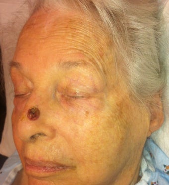 Nasal tumor/mole removal using plastic surgery techniques 1028082