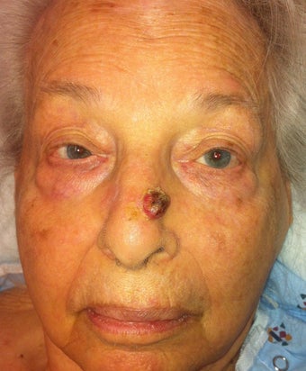Nasal tumor/mole removal using plastic surgery techniques before 1028082
