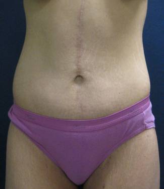Body Lift After Major Weightloss after 824409