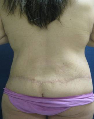 Body Lift After Major Weightloss 824409