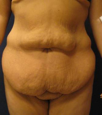 Body Lift After Major Weightloss before 824409
