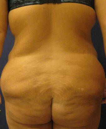 Body Lift After Major Weightloss 824409