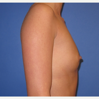 25-34 year old woman treated with Breast Implants (R. 295cc, L. 275cc) before 3544349