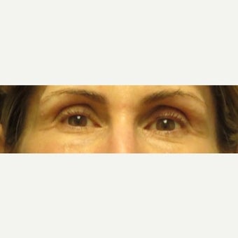Volume Loss In Eye Temples/Temporal Hallows Restored With Juvederm Voluma before 2045376