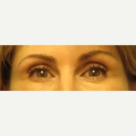 Volume Loss In Eye Temples/Temporal Hallows Restored With Juvederm Voluma after 2045376
