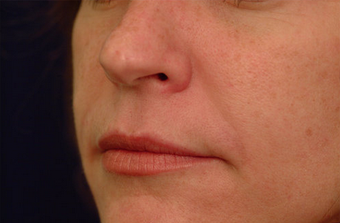 Juvederm after 82771
