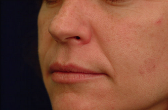Juvederm before 82771
