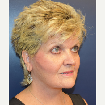55-64 year old woman treated with Lower Face Lift after 3188112