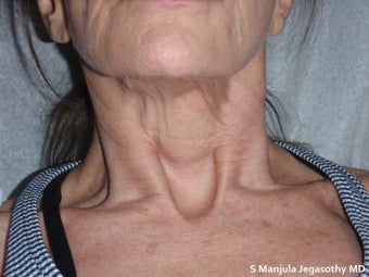 Platelet-Rich Plasma (PRP) Injections before 1652175