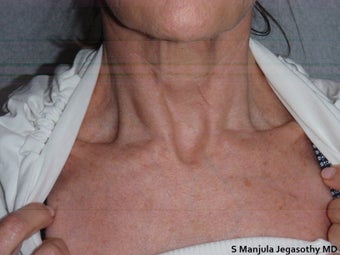 Platelet-Rich Plasma (PRP) Injections after 1652175