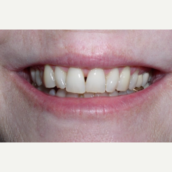 10 porcelain veneers before 3448732