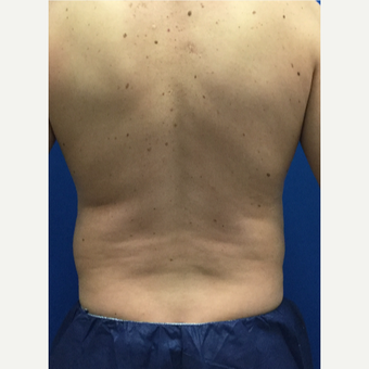 Male patient treated with Liposculpture before 3071899