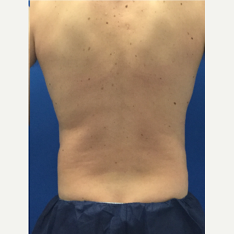 Male patient treated with Liposculpture after 3071899