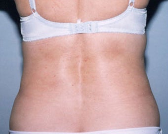 SmartLipo after 876521