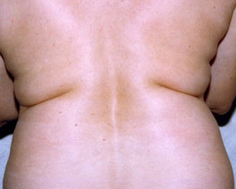 SmartLipo before 876521