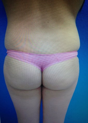 20 year old female treated with Brazilian Butt Lift Procedure before 1060062