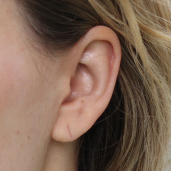 Ear Lobe Repair and Re-Piercing before 3310701