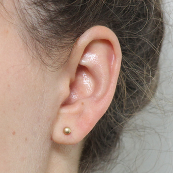 Ear Lobe Repair and Re-Piercing after 3310701