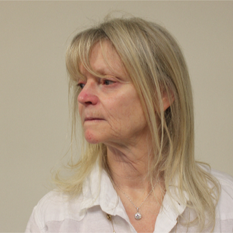 55-64 year old woman treated with Mini Lift before 3535848