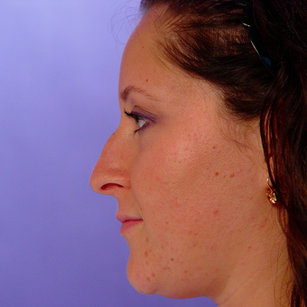 18-24 year old woman treated with Rhinoplasty before 3570323